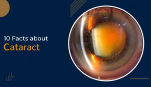 cataract surgery in Sydney