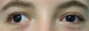 Right exotropia