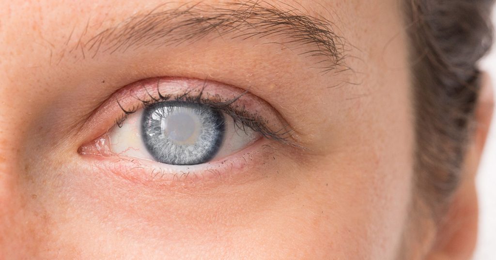 Diabetic Retinopathy
