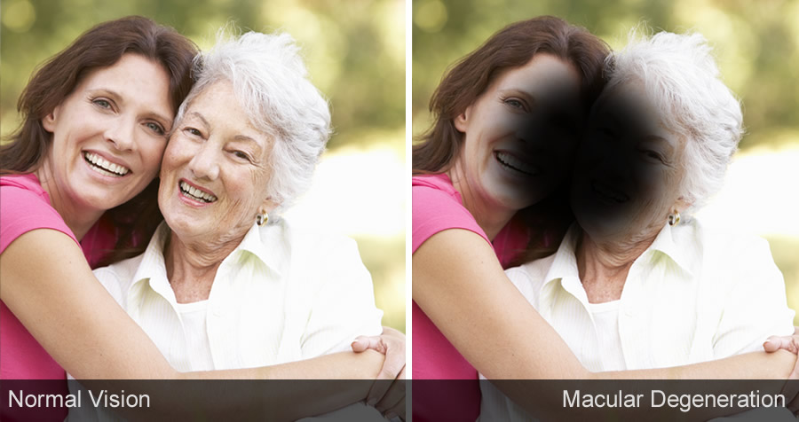 macular degeneration treatment