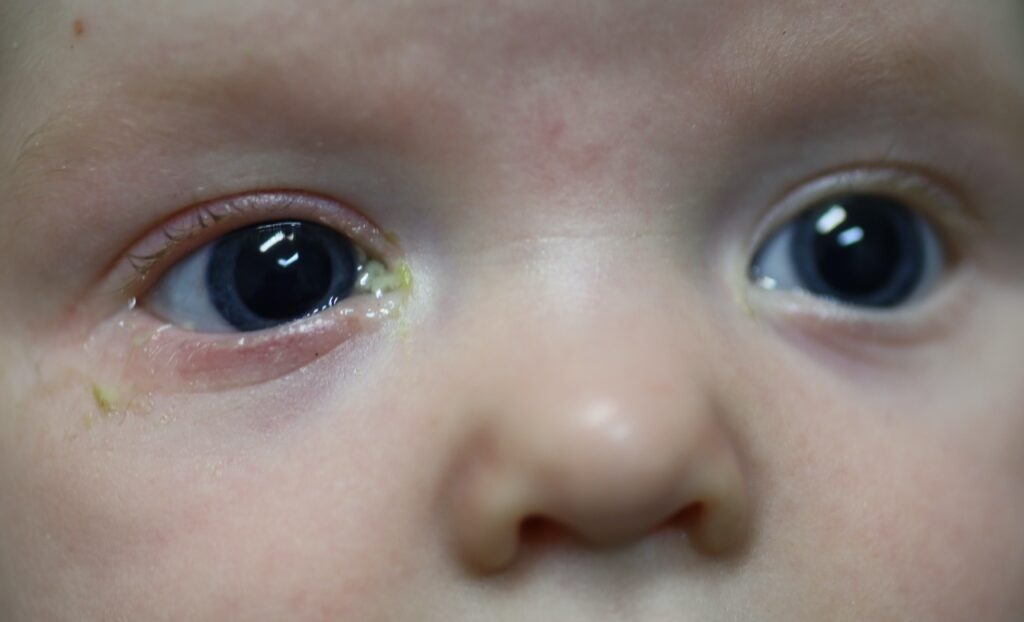 Blocked Tear Duct in Infants