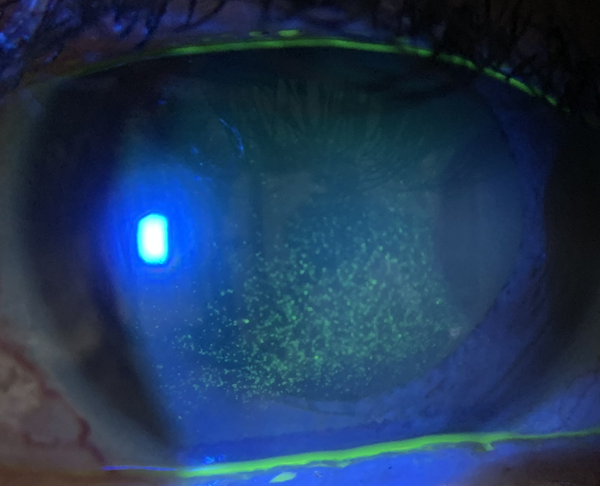 Erosion of cornea caused by dry eyes