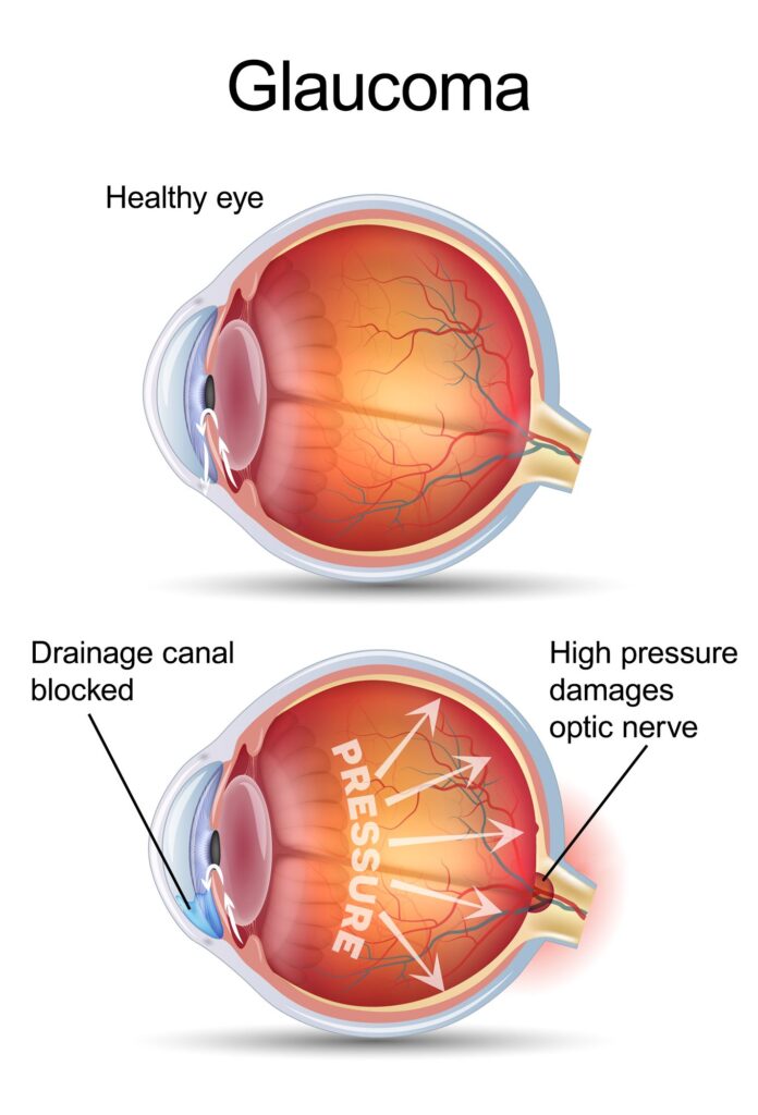 laser treatment for glaucoma