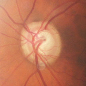 Glaucoma