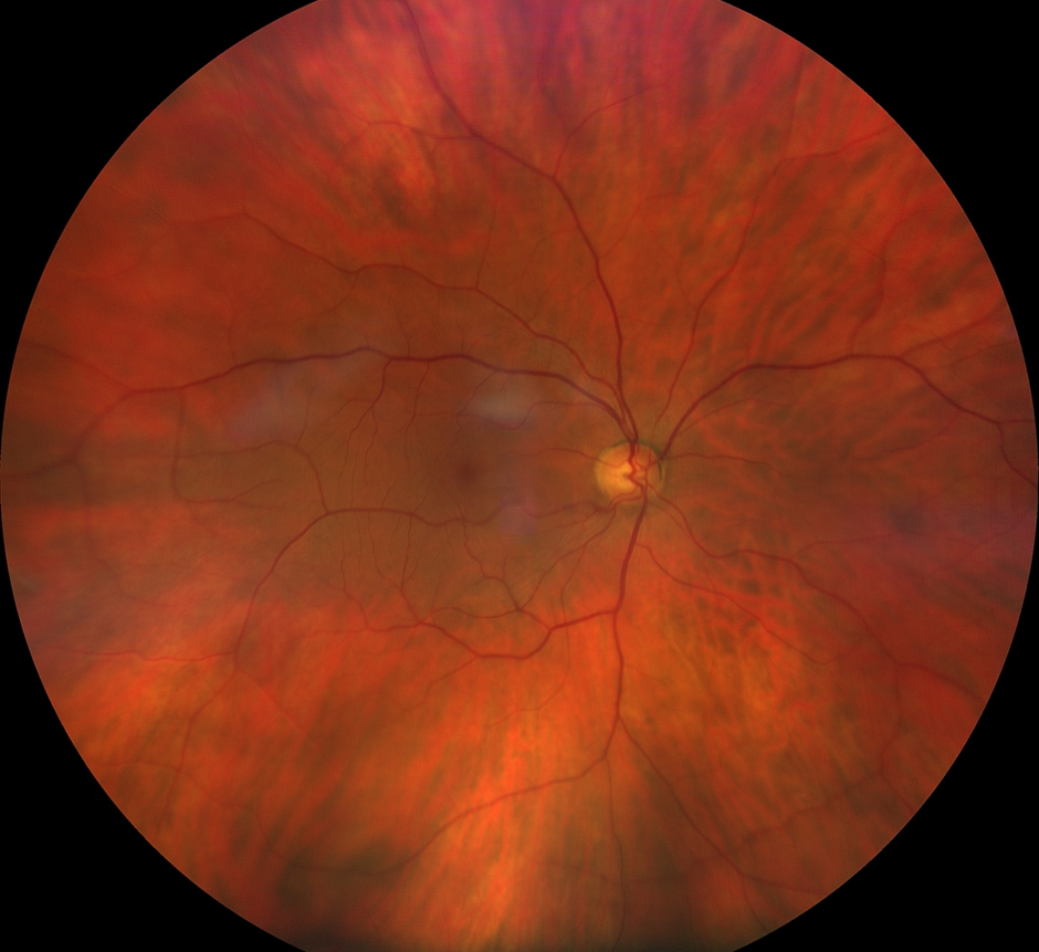 Right Eye: Attached retina