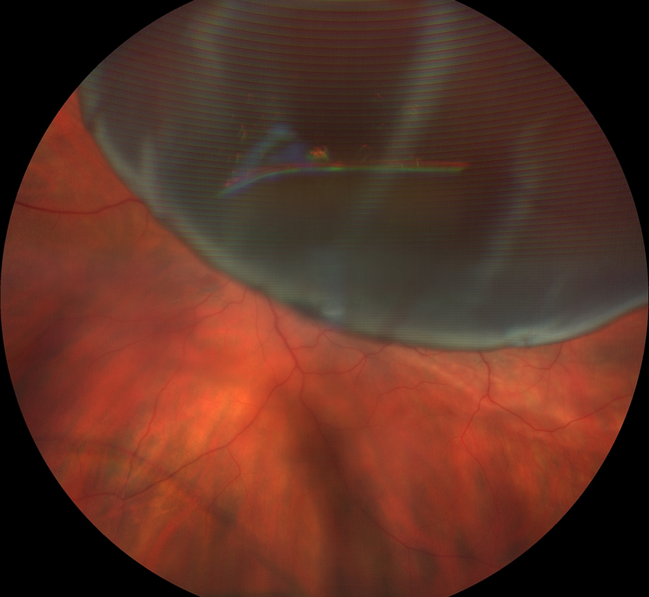 Left eye: detached retina