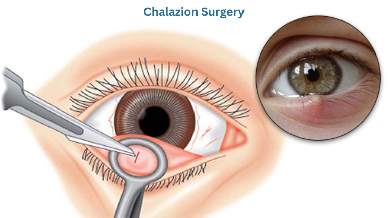 Chalazion Surgery: Symptoms, Causes, Treatment & After-care.