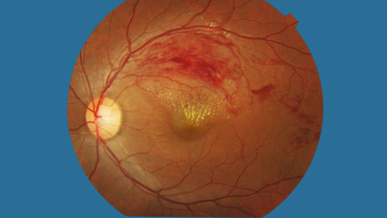 Retinal Scan With Rvo A Complete Guide to Understanding Eye Injections Clearly