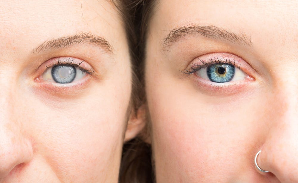 From Blurry to Clear: A Look at How Cataract Surgery Can Change Your Life