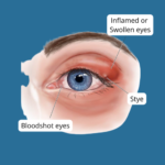 Ocular Rosacea: Causes, Symptoms, Diagnosis & Treatment