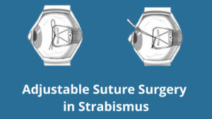 adjustable suture surgery in strabismus