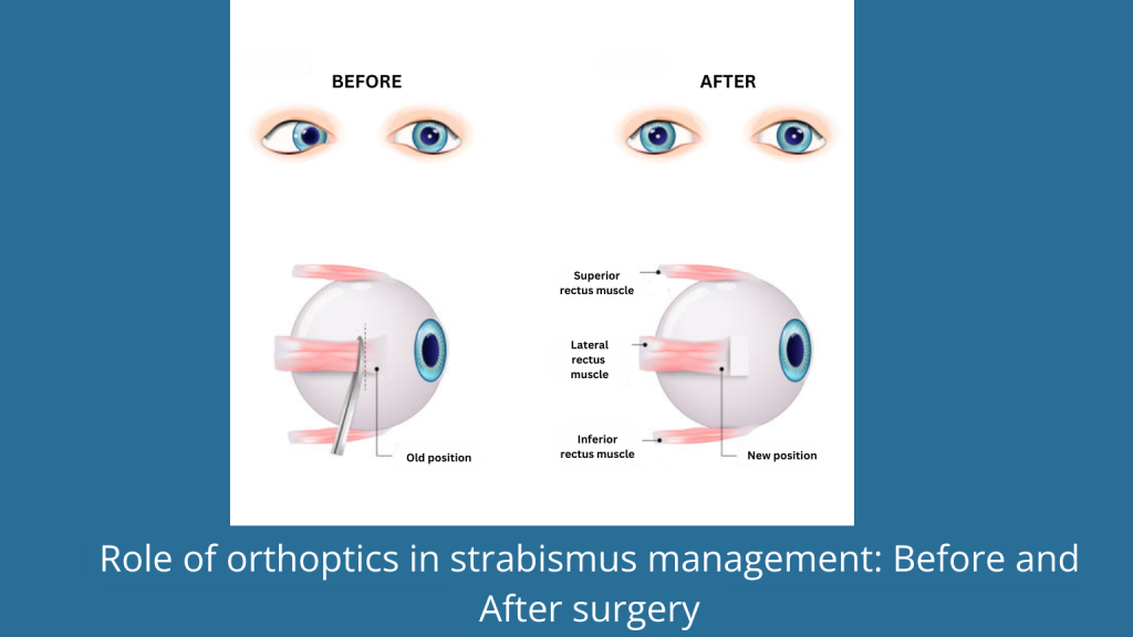 Role of orthoptics in strabismus management: Before and After surgery