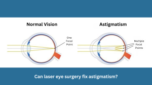 Can laser eye surgery fix astigmatism?