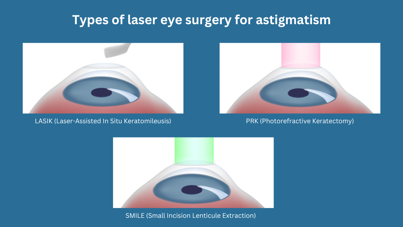 Can Laser Eye Surgery Fix Astigmatism Key Facts Explained Can Laser Eye Surgery Fix Astigmatism Key Facts Explained