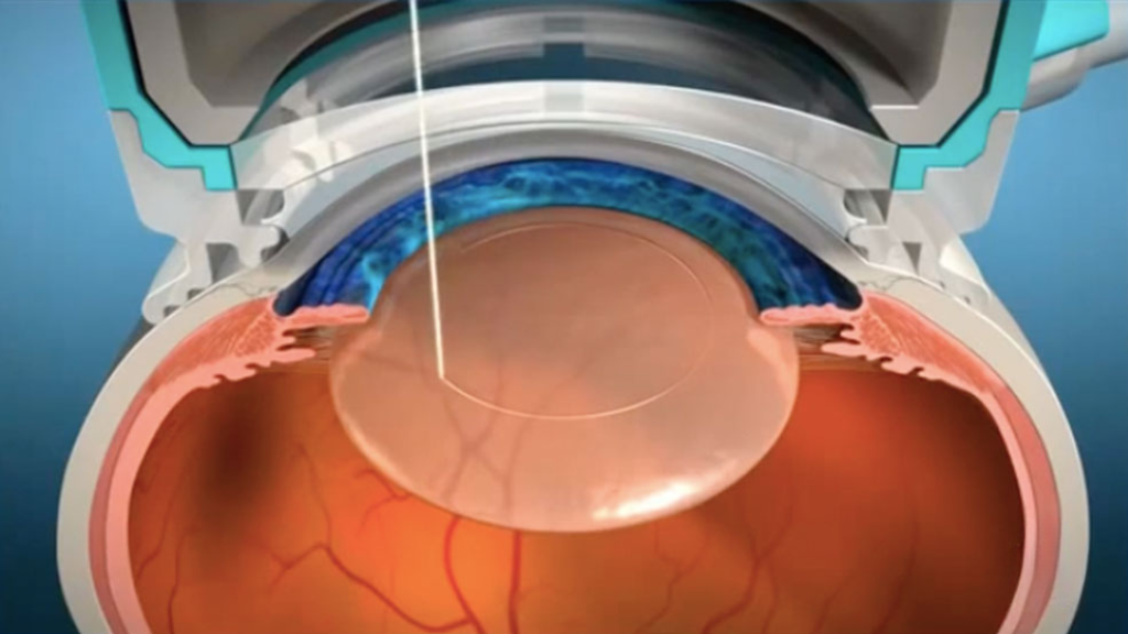 Femtosecond Laser-Assisted Cataract Surgery (FLACS)