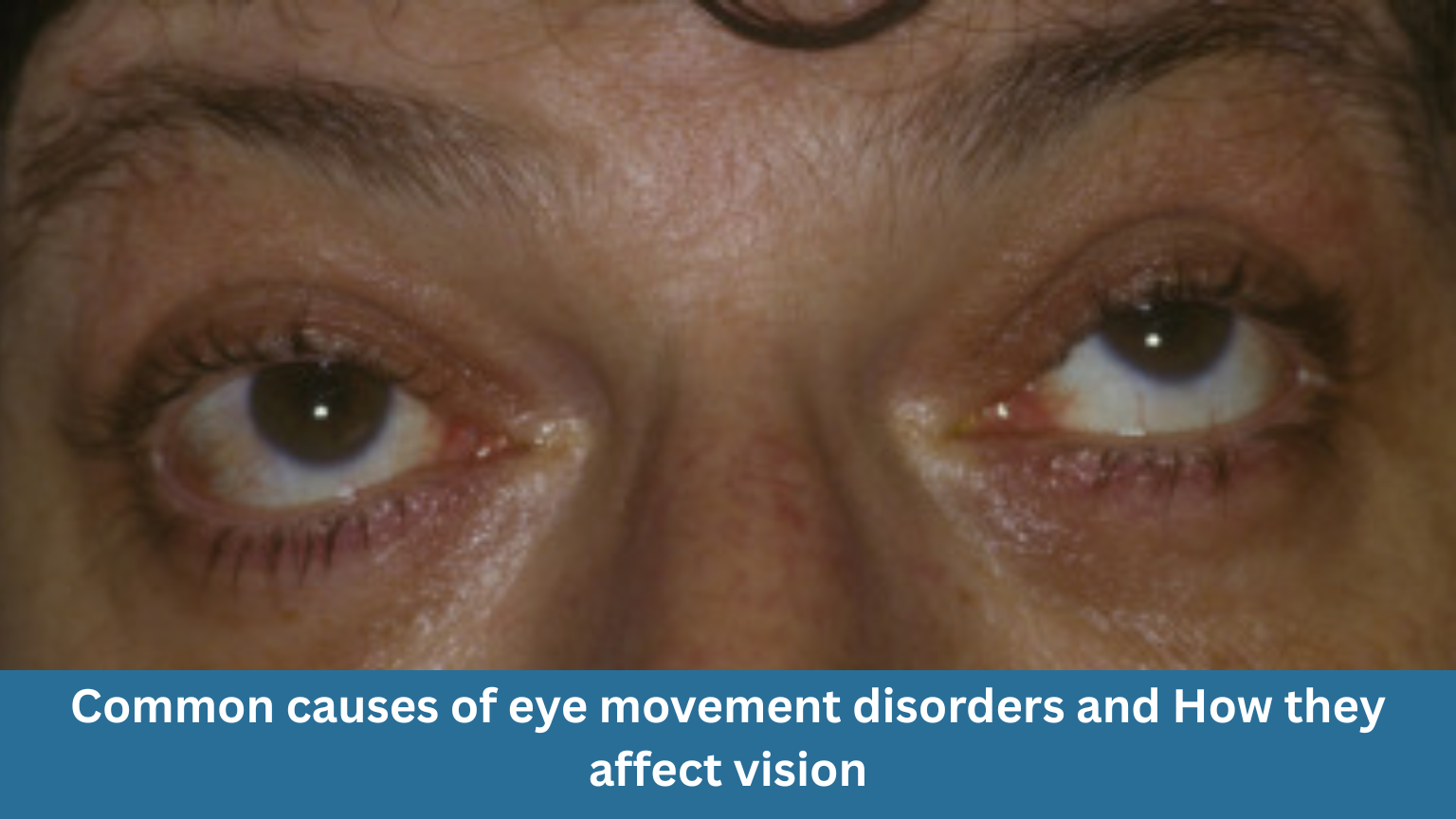Common causes of eye movement disorders & how they affect vision