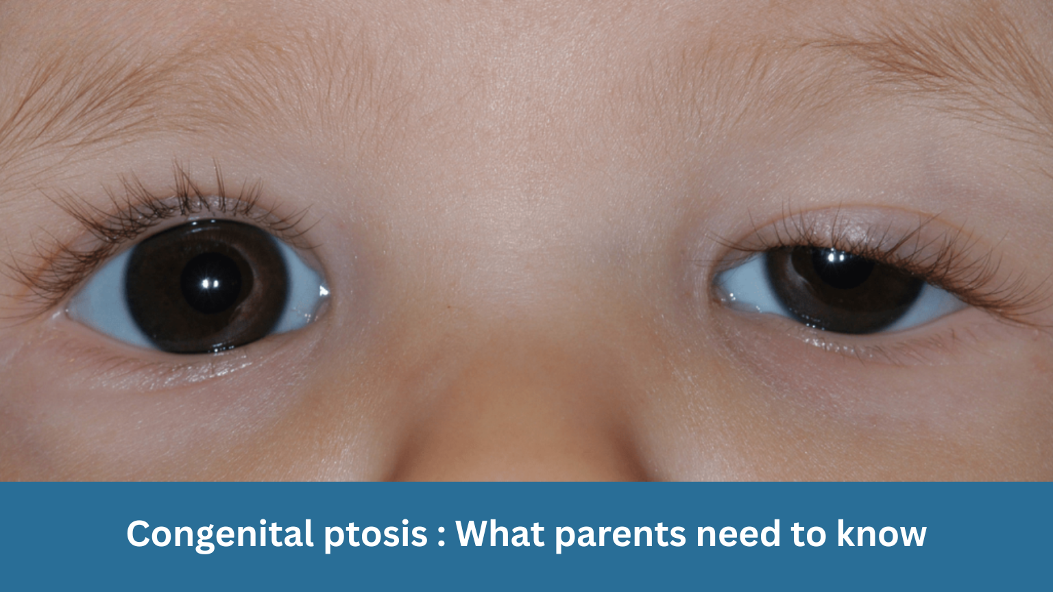 Congenital ptosis: What parents need to know