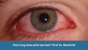 How long does pink eye last? Viral Vs. Bacterial