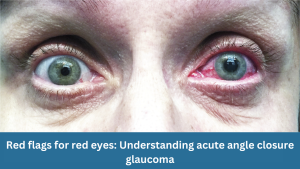 Red flags for red eyes: Understanding acute angle closure glaucoma