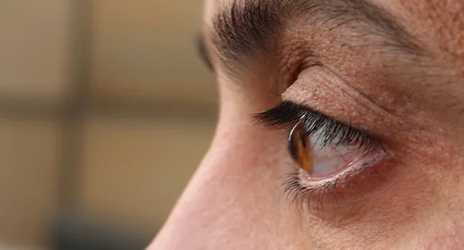 Keratoconus and other corneal diseases