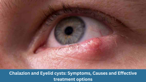 Chalazion and Eyelid cysts: Symptoms, Causes and Effective treatment options