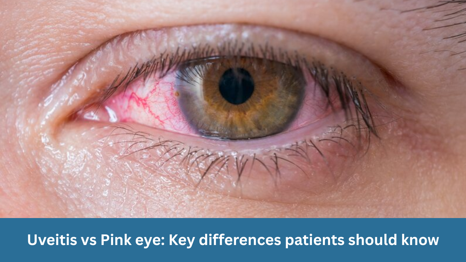 Uveitis vs Pink eye: Key differences patients should know