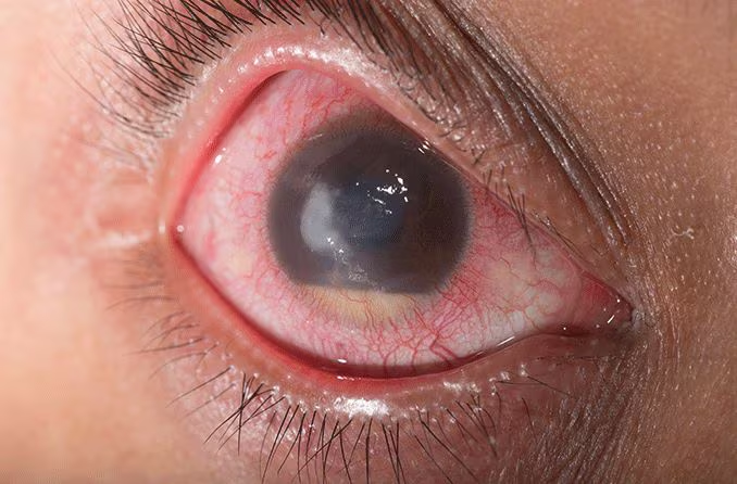 Infection or inflammation (rare but serious)