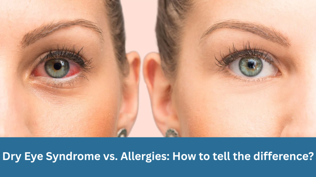 Dry Eye Syndrome vs. Allergies: How to tell the difference?