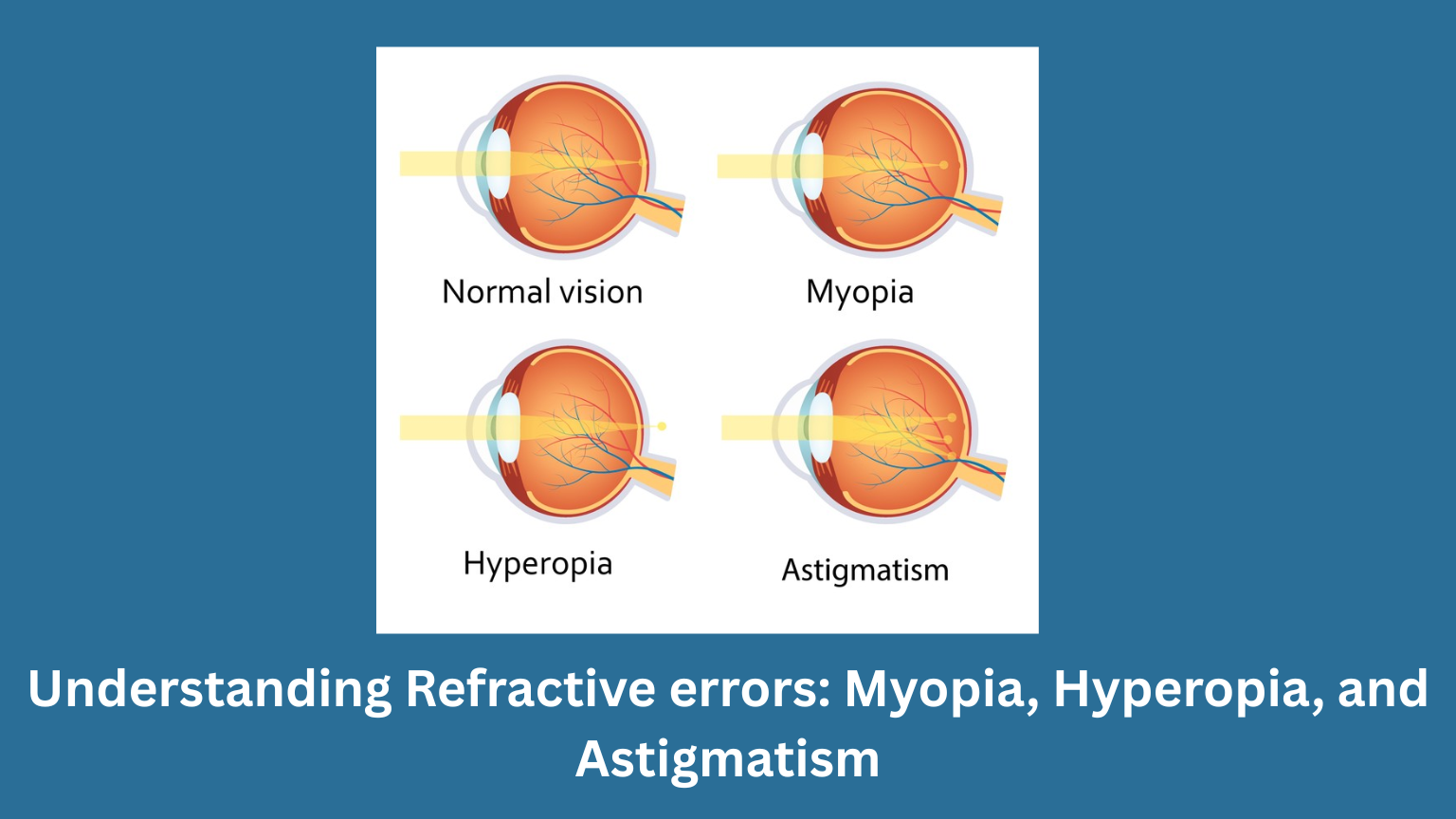 Understanding refractive errors: Myopia, hyperopia, and astigmatism
