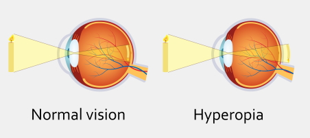 Hyperopia (Long-sightedness)