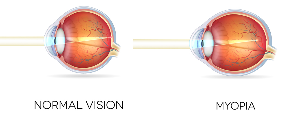 Myopia (Short-sightedness)