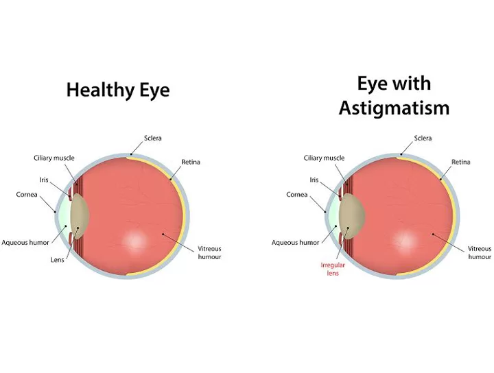 Astigmatism
