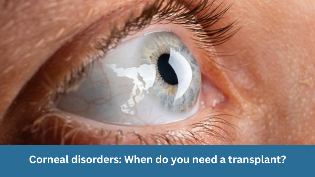 Corneal disorders: When do you need a transplant?