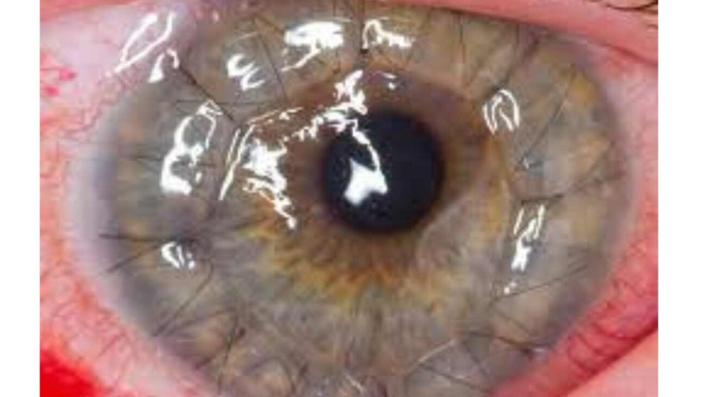How does a doctor decide if a corneal transplant is needed?