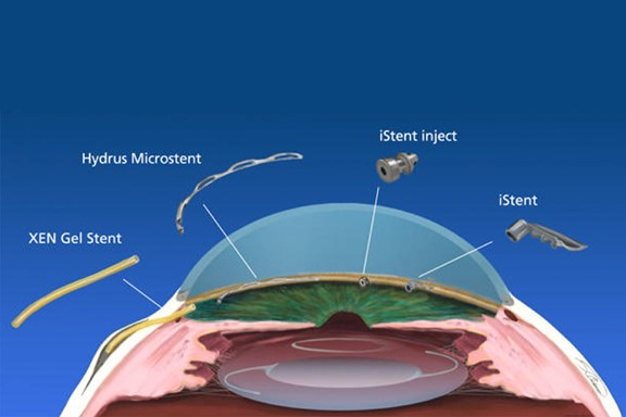 What is minimally invasive eye surgery?
