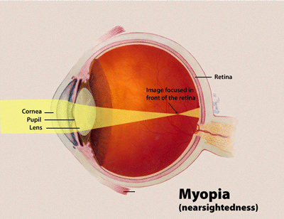 High myopia.