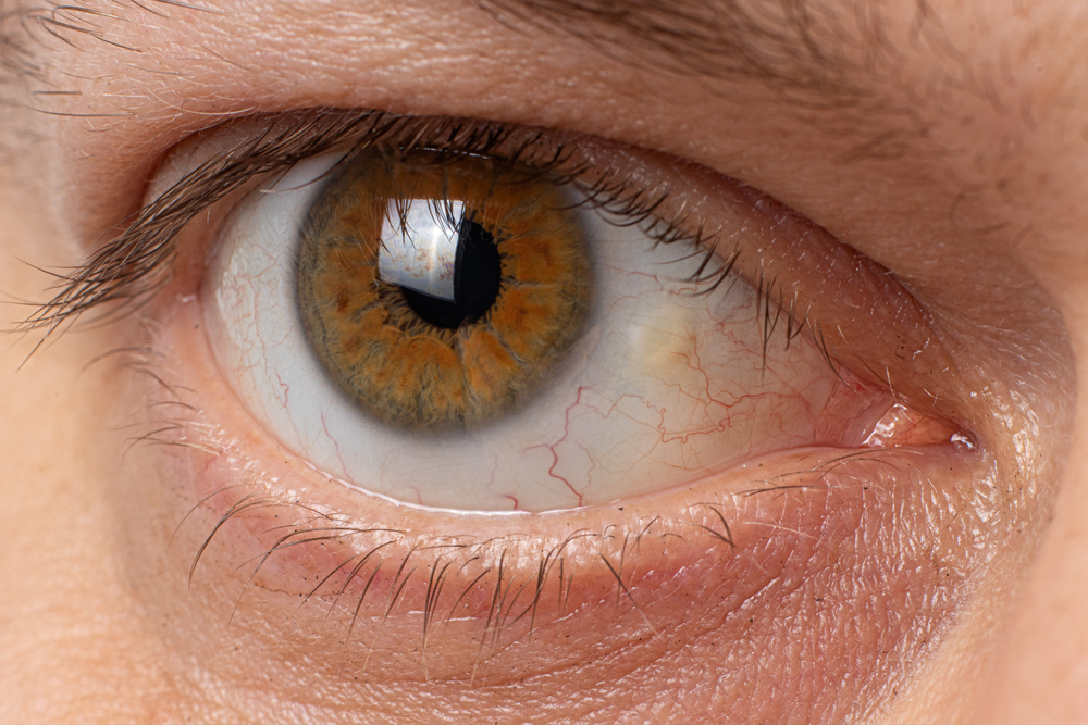 Can corneal transplant be avoided in early stages?