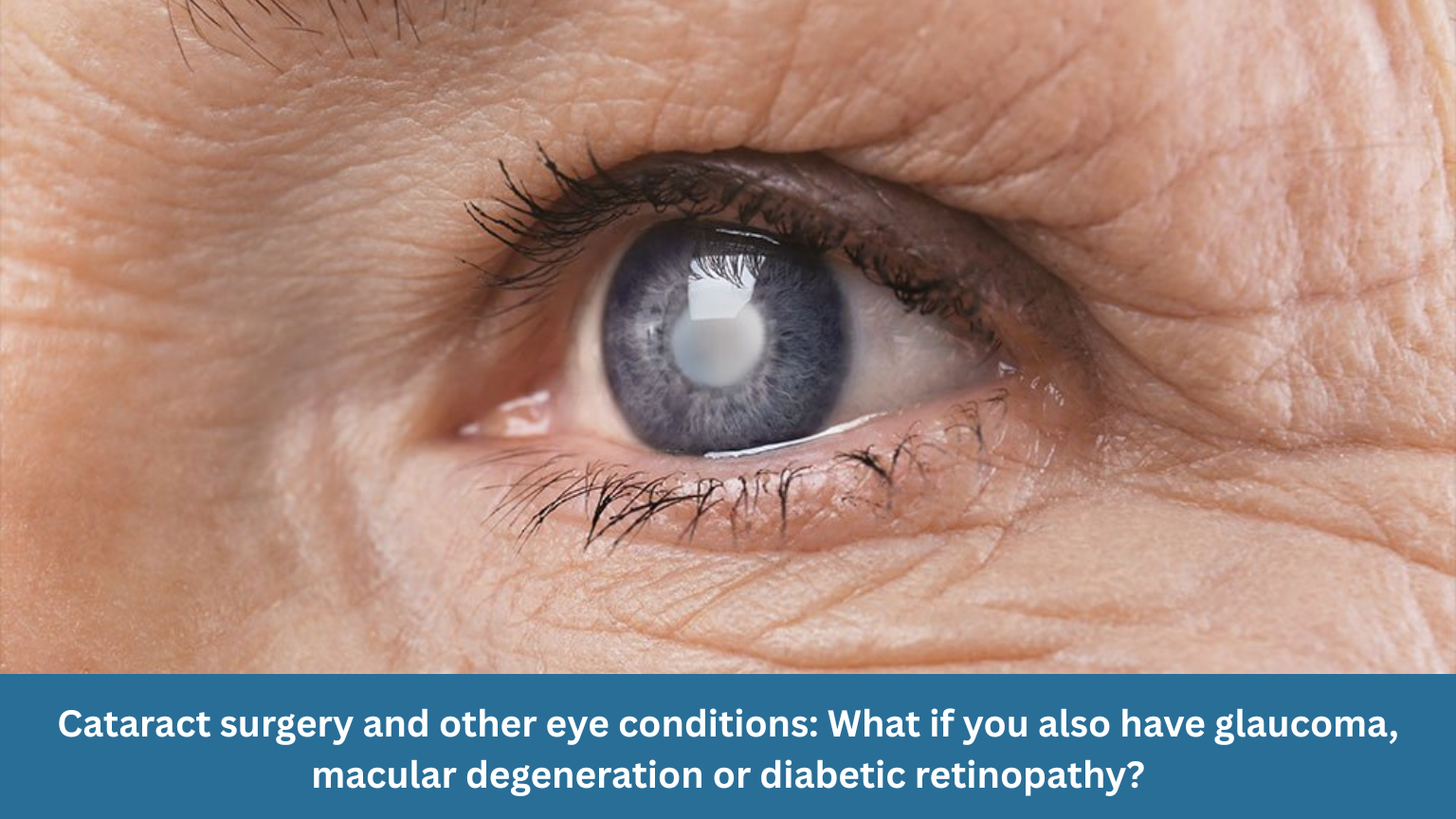 Eye care after 60 – age-related eye conditions including cataracts, glaucoma and macular degeneration in Canberra