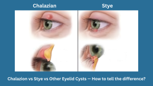 Chalazion vs Stye vs Other Eyelid Cysts — How to tell the difference?