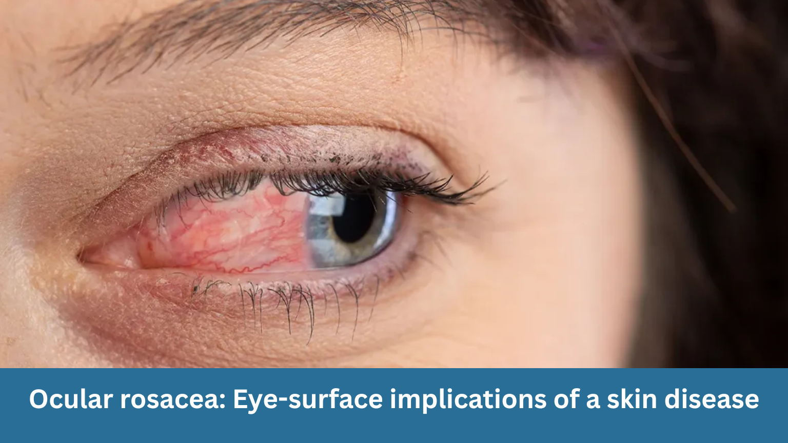 Ocular rosacea: Eye-surface implications of a skin disease