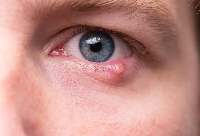 How are eyelid lumps treated?
