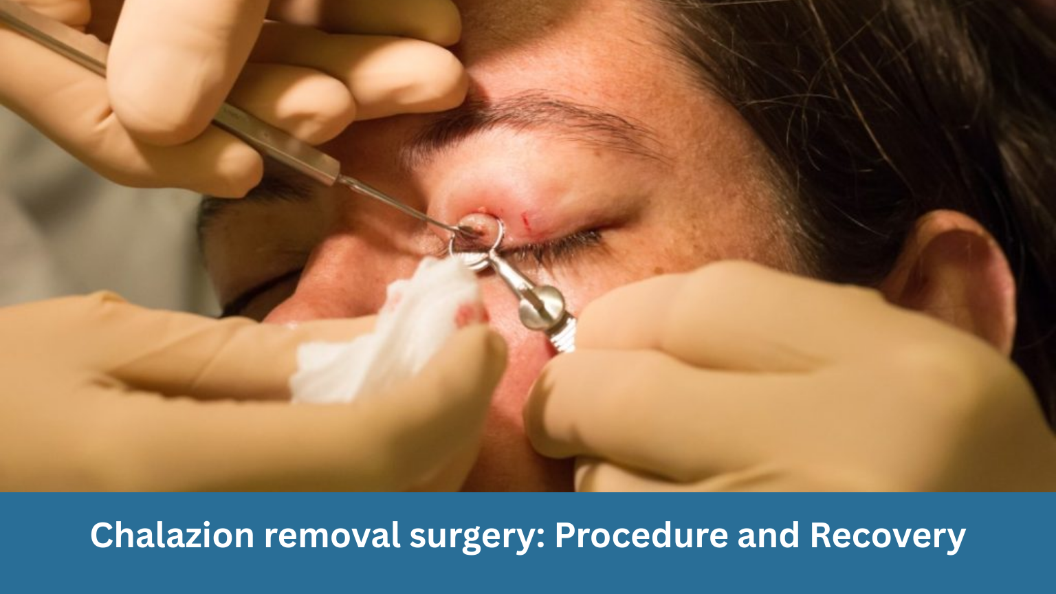 Chalazion removal surgery: Procedure and Recovery