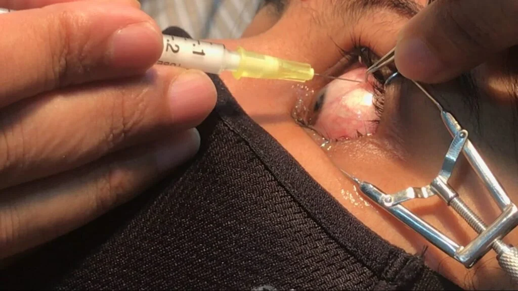 Are eye injections safe?