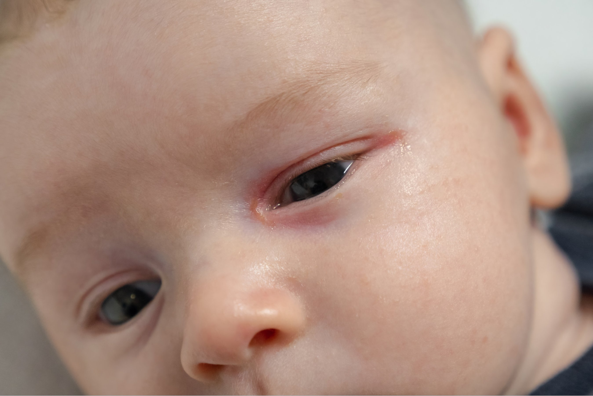 Does tear duct blockage go away on its own?
